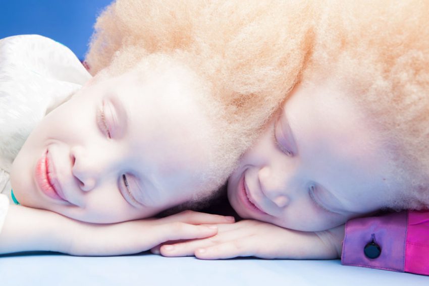 albino-twins-models-2-58e74afe0115f__880-850x567.jpg